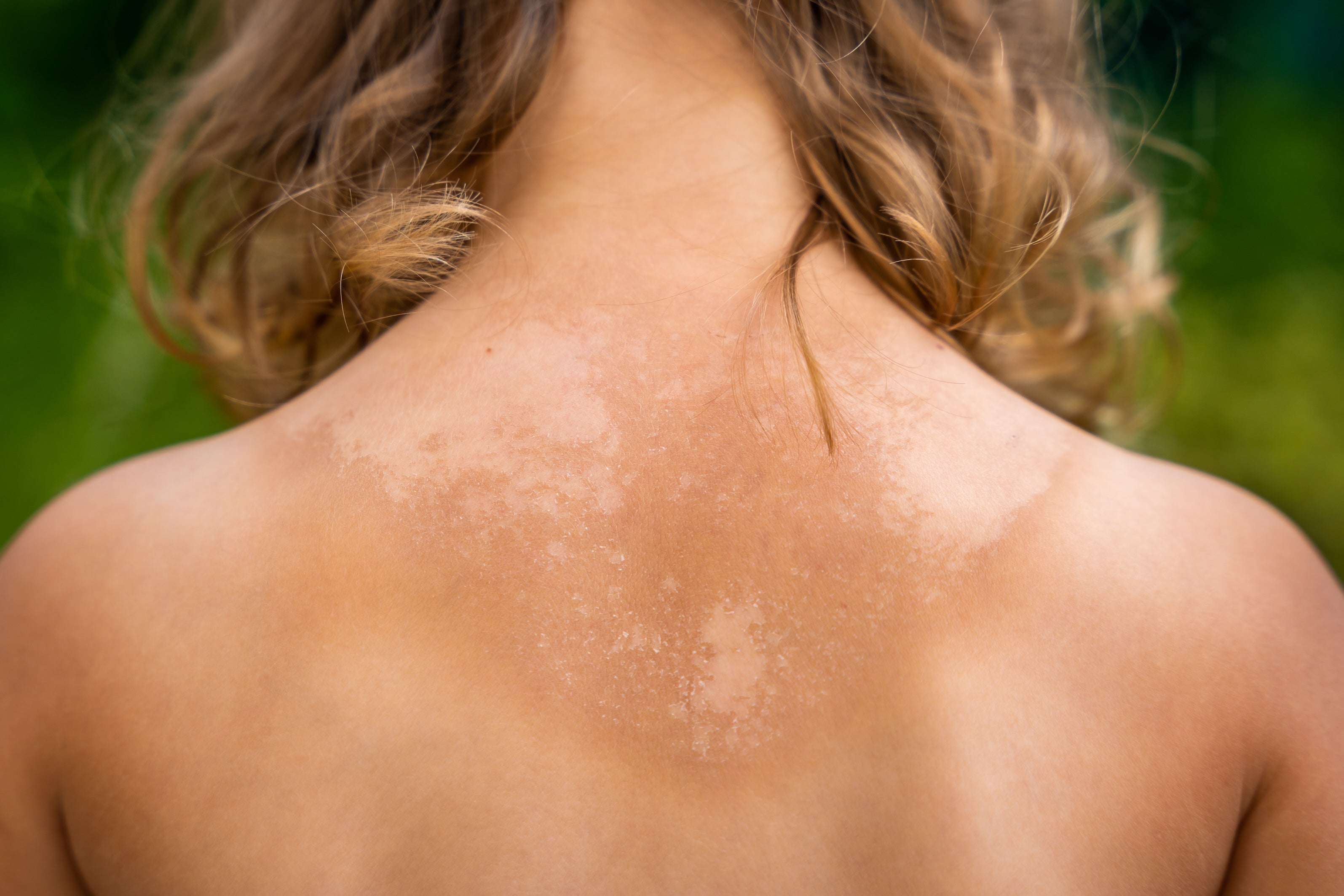 Sun Damage